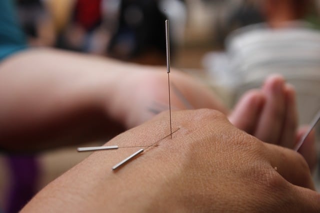 מחטי דיקור סיני ביד בזמן טיפול דיקור סיני acupuncture needles in hands during acupuncture treatment